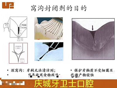 愛(ài)牙科普-來(lái)自臨床的窩溝封閉