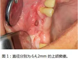 上頜竇瘺修補術——改良式旋轉帶蒂粘膜瓣修補術的應用