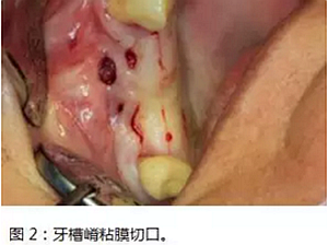 上頜竇瘺修補術——改良式旋轉帶蒂粘膜瓣修補術的應用