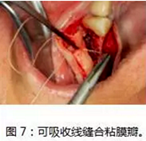 上頜竇瘺修補術——改良式旋轉帶蒂粘膜瓣修補術的應用