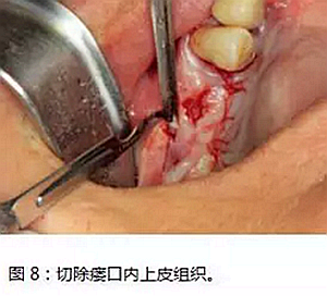 上頜竇瘺修補術——改良式旋轉帶蒂粘膜瓣修補術的應用
