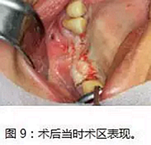上頜竇瘺修補術——改良式旋轉帶蒂粘膜瓣修補術的應用