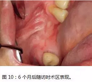 上頜竇瘺修補術——改良式旋轉帶蒂粘膜瓣修補術的應用