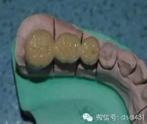 是什么導致了義齒返工？？？