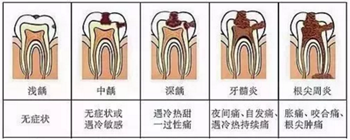 牙齒從針眼大的洞到拔除，步步驚心！