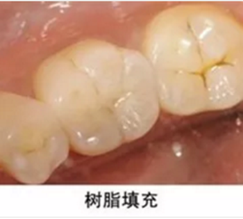 完全不懂，各種補(bǔ)牙材料，到底怎么選？