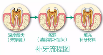 完全不懂，各種補(bǔ)牙材料，到底怎么選？