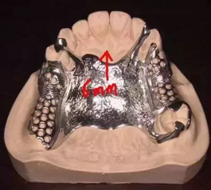 活動(dòng)義齒修復(fù)，要懂的鋼托設(shè)計(jì)