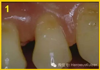 簡單治療——格魯瑪脫敏劑的應(yīng)用