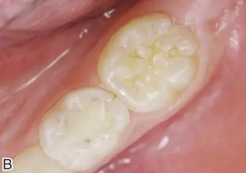 預(yù)防齲齒，口腔醫(yī)生能幫我做什么？局部用氟、窩溝封閉、預(yù)防性樹(shù)脂充填都是什么？