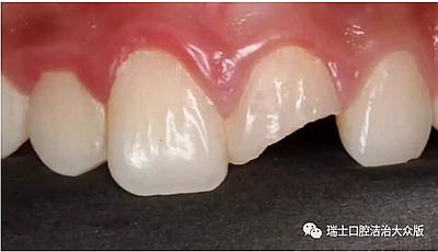 成人牙齒外傷了怎么應急處理？