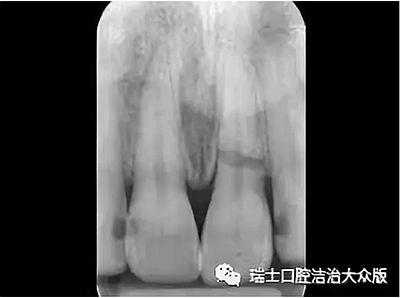 成人牙齒外傷了怎么應急處理？