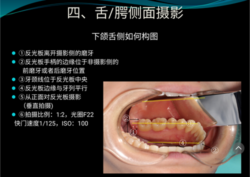 口內照攝影方法與技巧分享