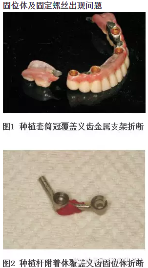 【經驗分享】無牙頜種植修復固位的并發癥與處理——宋應亮教授