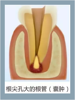 多頻技術的根管長度測定儀