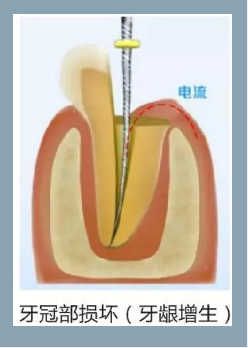 多頻技術的根管長度測定儀