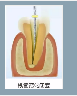 多頻技術的根管長度測定儀