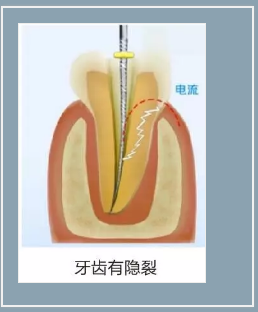 多頻技術的根管長度測定儀