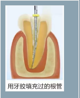 多頻技術的根管長度測定儀