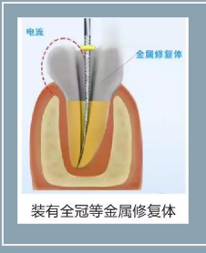 多頻技術的根管長度測定儀