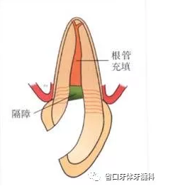 上前牙根管再治療后內漂白1例