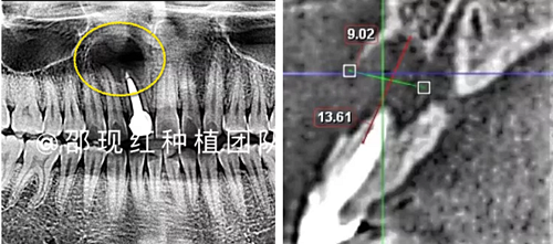 「科普篇」你真的了解它嗎？——β-磷酸三鈣