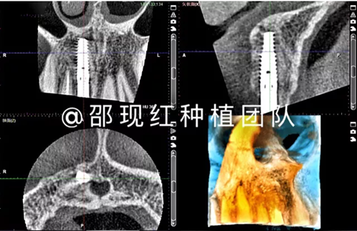 「科普篇」你真的了解它嗎？——β-磷酸三鈣