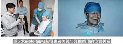病例報道│全程數字化輔助無牙頜種植即刻負重