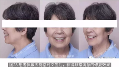 病例報道│全程數字化輔助無牙頜種植即刻負重