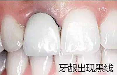 	烤瓷牙出現問題【不要猶豫】盡快去醫院拆除！