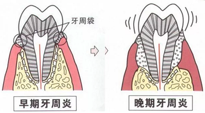 上海嘉福口腔研究所二十一世紀牙周病的臨床進展