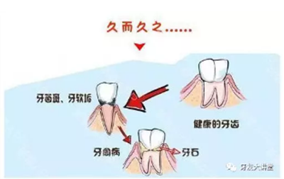 牙周炎，中國成年人后半生永遠的 痛 ！