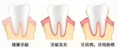牙周炎，中國成年人后半生永遠的 痛 ！