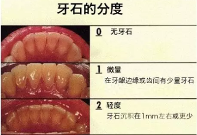牙周炎，中國成年人后半生永遠的 痛 ！