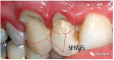 牙周炎，中國成年人后半生永遠的 痛 ！