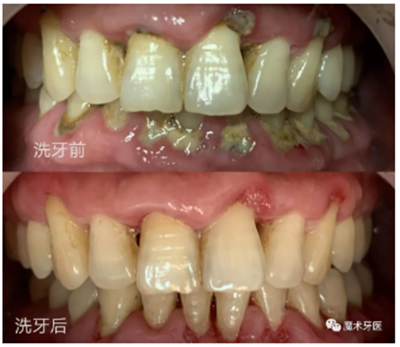 牙周炎，中國成年人后半生永遠的 痛 ！