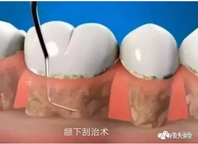牙周炎，中國成年人后半生永遠的 痛 ！