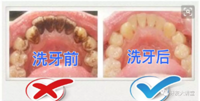 牙周炎，中國成年人后半生永遠的 痛 ！