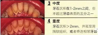 牙周炎，中國成年人后半生永遠的 痛 ！