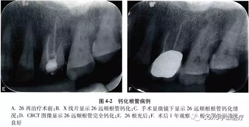 （六期）細小鈣化根管的疏通——病因及診斷