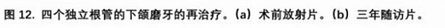 宇森SC-Pro鎳鈦根管銼|宇森醫療根管治療器械領跑者