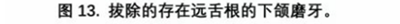 宇森SC-Pro鎳鈦根管銼|宇森醫療根管治療器械領跑者