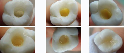 各類洞形的樹(shù)脂充填方法
