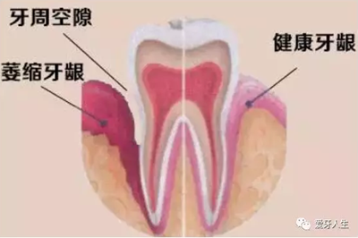 什么是牙齦萎縮？