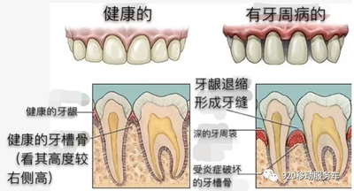 什么是牙齦萎縮？