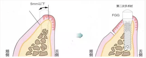種植體周?chē)腔l的獲得時(shí)期與方法