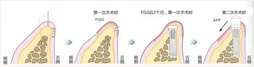 種植體周?chē)腔l的獲得時(shí)期與方法