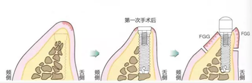 種植體周?chē)腔l的獲得時(shí)期與方法