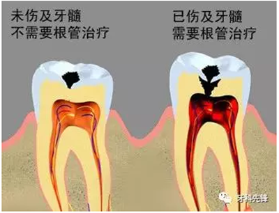 補牙不做冠，療效少一半！根管治療后牙齒已經(jīng)不疼了，為什么還要戴牙冠呢？