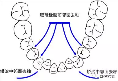 鄰面去釉技術詳解